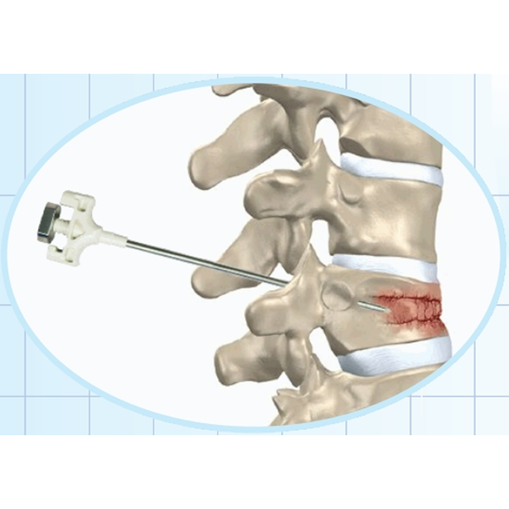 Osteo Cement Needle